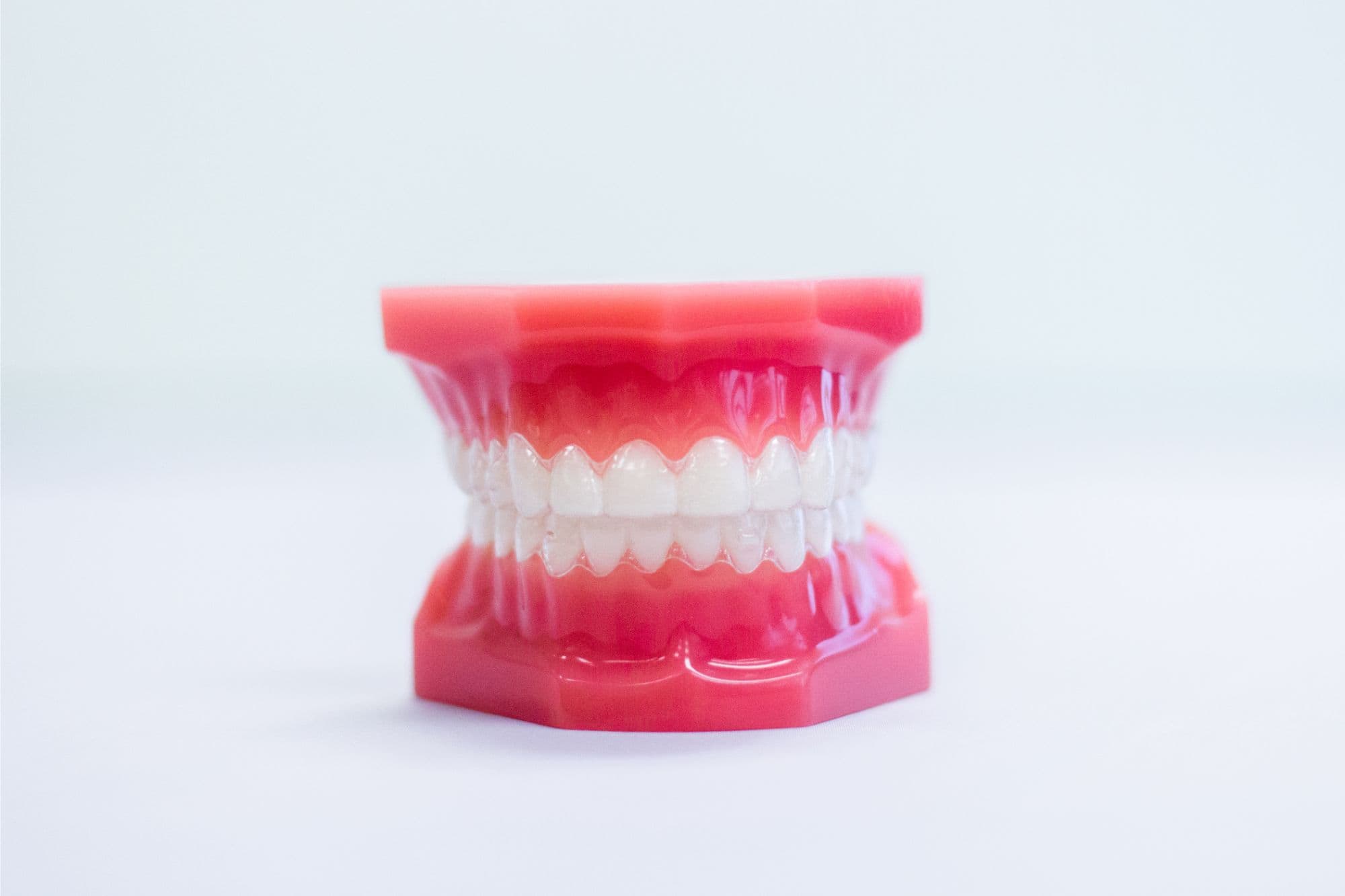 Dental model of teeth fitted with Invisalign clear aligners at Luv Braces