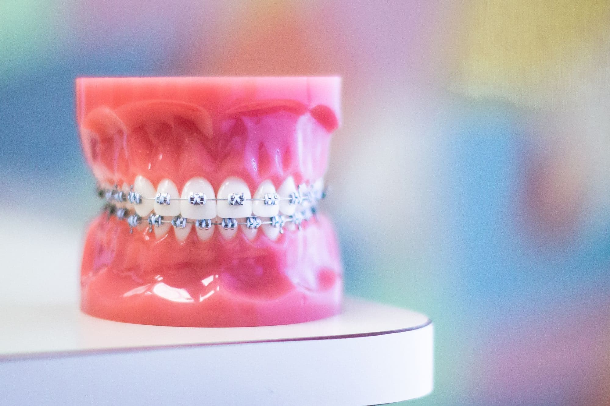 Front view of a dental model showing metal braces at Luv Braces