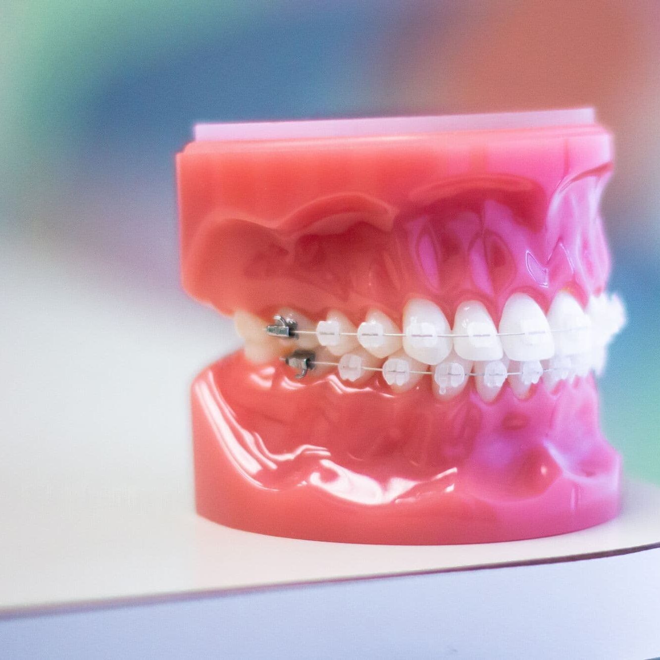 Dental model of teeth fitted with clear ceramic braces at Luv Braces