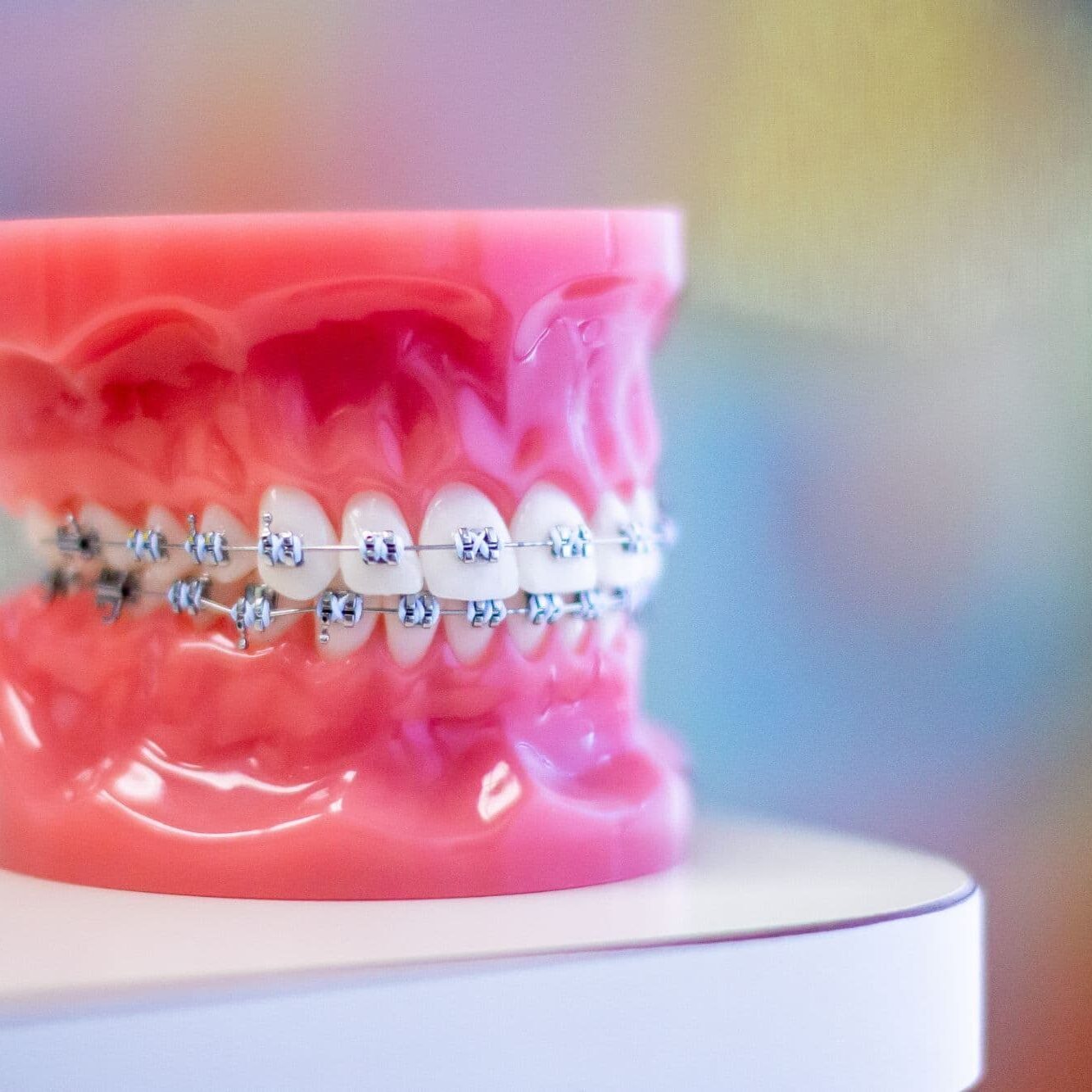 Side view of a dental model fitted with metal braces at Luv Braces